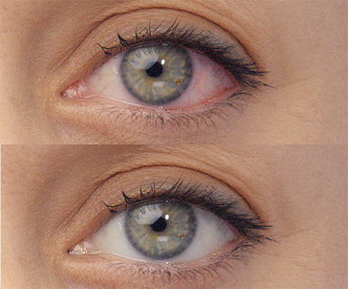 Average results before and after using LUMIFY eye drops on light blue-green eyes. Before shows an eye with redness and after shows the same eye but with whiter, brighter whites of the eyes.